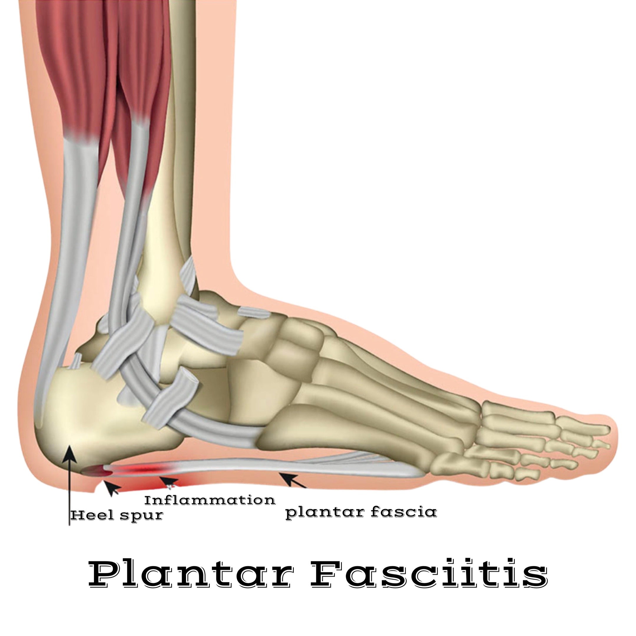 plantar fasciitis wedge