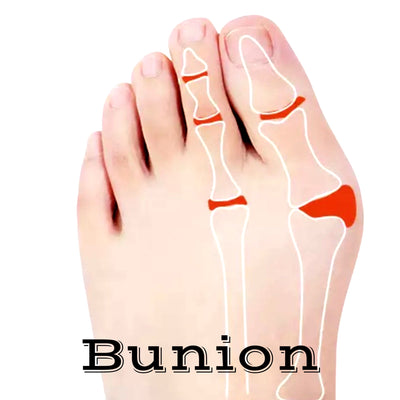 Bunion and Barefoot shoes