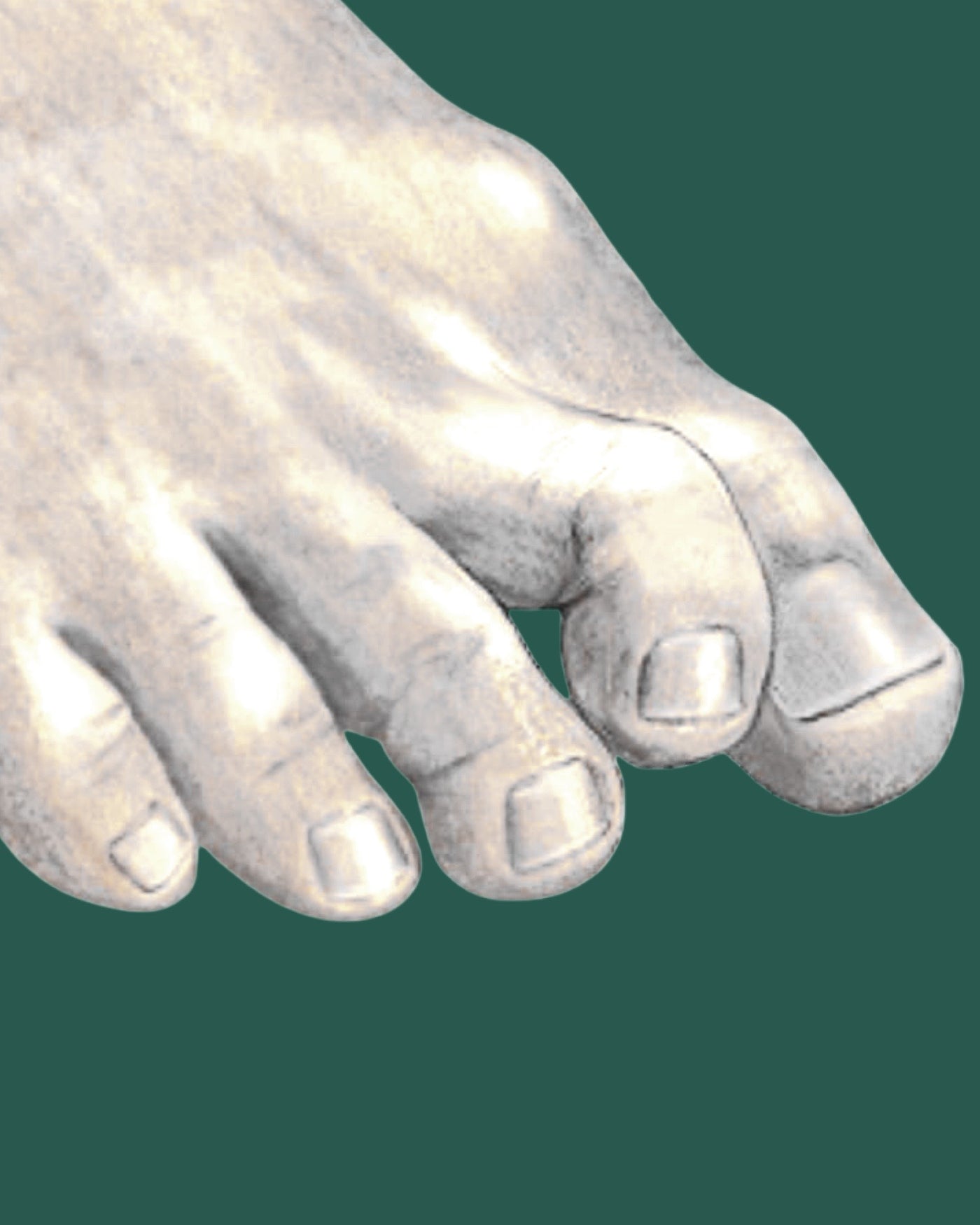 Thickened Toenails | Mississauga Foot Clinic
